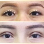 Before and after upper eyelid surgery results at Asia Cosmetic Hospital, eyelid lift improvement