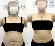 Vorher-nachher-Ergebnis der Fettabsaugung bei Munare Clinic – sichtbare Bauchkontur