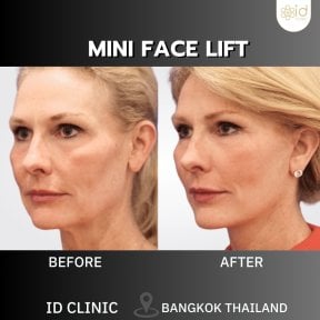 before-after photo rhinoplasty-nose-job