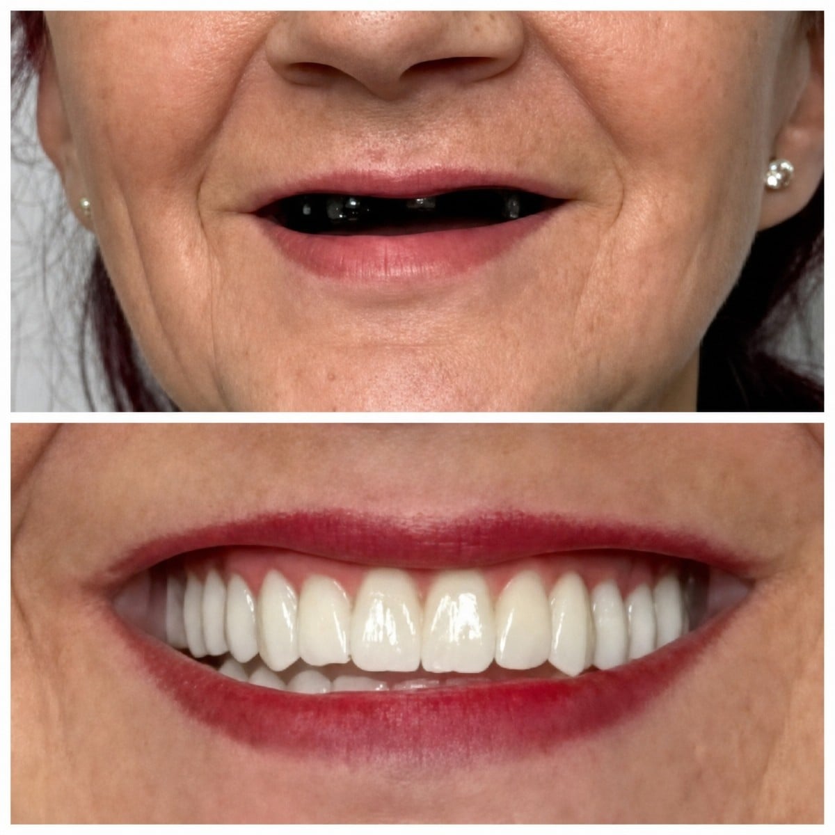 نتائج قبل وبعد زراعة الأسنان في Santa Caterina Clinic – ابتسامة مستعادة