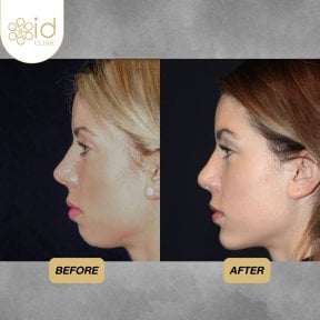 Before and after chin implant results at ID Clinic Bangkok, enhanced chin profile and contour