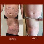 Before and after tummy tuck and liposuction results at DGB Clinic, improved abdominal contour