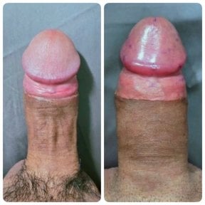 Resultados antes y después de relleno de pene en Eternity Clinic Pleonchit, mayor grosor visible