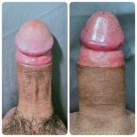 Resultados antes y después de relleno de pene en Eternity Clinic Pleonchit, mayor grosor visible