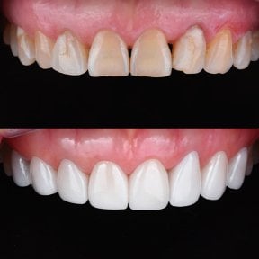 نتائج قبل وبعد عدسات الأسنان الخزفية في 365SeoulOneTop365 Dental Clinic، تجميل الابتسامة