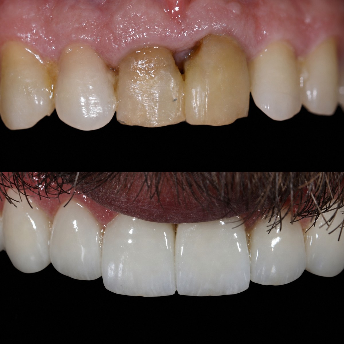 نتائج قبل وبعد تركيب تيجان الزركونيا في Grand Dental Hospital & Laboratory، ترميم الابتسامة