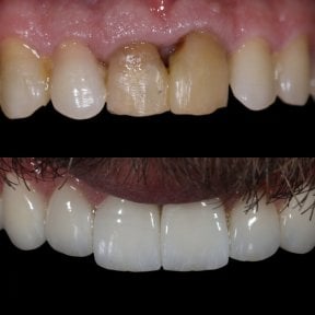 Before and after zirconia crown results at Grand Dental Hospital & Laboratory, smile restoration