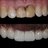 Before and after zirconia crown results at Grand Dental Hospital & Laboratory, smile restoration