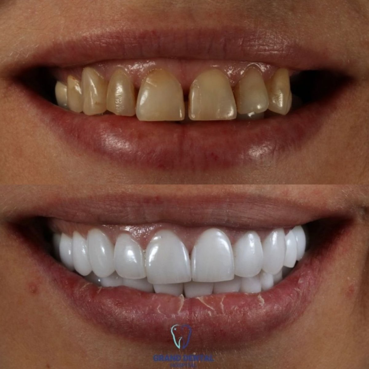 Resultados antes y después de coronas de zirconia en Grand Dental Hospital & Laboratory, sonrisa
