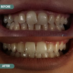 Before and after Invisalign results at Grand Dental Hospital & Laboratory, teeth alignment improvement