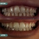 Before and after Invisalign results at Grand Dental Hospital & Laboratory, teeth alignment improvement