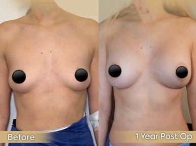 Vorher-nachher-Ergebnis Brustimplantate mit Straffung bei Dr. Safa Manav, 1 Jahr post-op