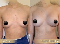 Vorher-nachher-Ergebnis Brustimplantate mit Straffung bei Dr. Safa Manav, 1 Jahr post-op