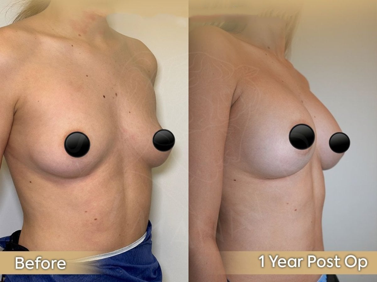 Resultados antes y después de implantes y lifting de senos en Dr. Safa Manav Clinic, 1 año