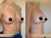 Vorher-nachher-Ergebnis Brustimplantate mit Straffung bei Dr. Safa Manav Clinic, 1 Jahr