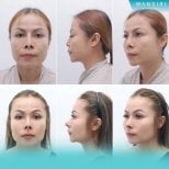 Before and after mini facelift results at Wansiri Hospital, facial rejuvenation and contouring