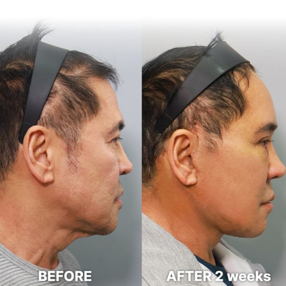 Resultados de minilifting facial antes y después en Returning Plastic Surgery, rejuvenecimiento