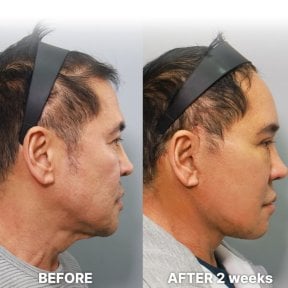 Результаты мини-подтяжки лица до и после в Returning Plastic Surgery, омоложение лица