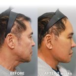 Результаты мини-подтяжки лица до и после в Returning Plastic Surgery, омоложение лица