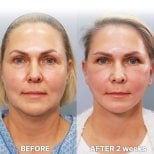 Результаты мини-подтяжки лица до и после в Returning Plastic Surgery, омоложение лица