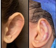 Otoplastik Vorher-Nachher-Ergebnisse bei Assoc.Prof.Dr.Cemal Kara / Medical Park İzmir Hospital