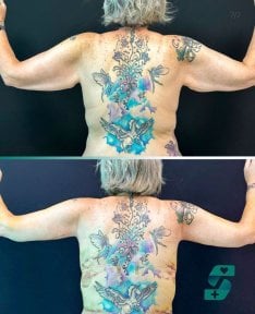 Before and after arm lift (brachioplasty) results at Soraca Med – improved arm contour