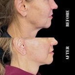 Résultat avant/après lifting deep plane à Artisan Clinic, raffermissement visible du cou et de la mâchoire