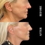 Résultats avant et après lifting Deep Plane à Artisan Clinic, rajeunissement facial visible