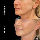 Before and after Deep Plane Facelift results at Artisan Clinic, visible facial rejuvenation