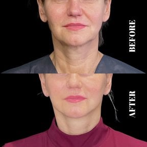 Résultats avant et après Deep Plane Facelift à Artisan Clinic, rajeunissement facial visible