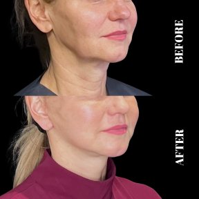 Результати до і після Deep Plane Facelift в Artisan Clinic, помітний ліфтинг шиї та щелепи