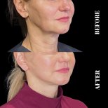 Результати до і після Deep Plane Facelift в Artisan Clinic, помітний ліфтинг шиї та щелепи