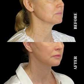 Before and after Deep Plane Facelift results at Artisan Clinic, visible facial rejuvenation