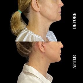 Before and after deep plane facelift result at Artisan Clinic, visible jawline and neck lift