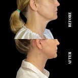 Before and after deep plane facelift result at Artisan Clinic, visible jawline and neck lift