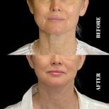 Vorher-nachher-Ergebnis Deep Plane Facelift bei Artisan Clinic, sichtbare Verjüngung