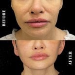 Before and after Deep Plane Facelift results at Artisan Clinic, visible facial rejuvenation
