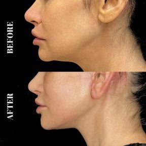 Résultats avant/après lifting deep plane à Artisan Clinic, ovale du visage et cou raffermis