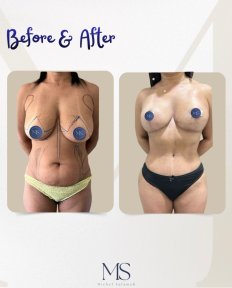 Mommy makeover before and after results at Michel Salameh Clinic – body and breast contouring
