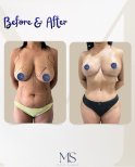 Mommy makeover before and after results at Michel Salameh Clinic – body and breast contouring