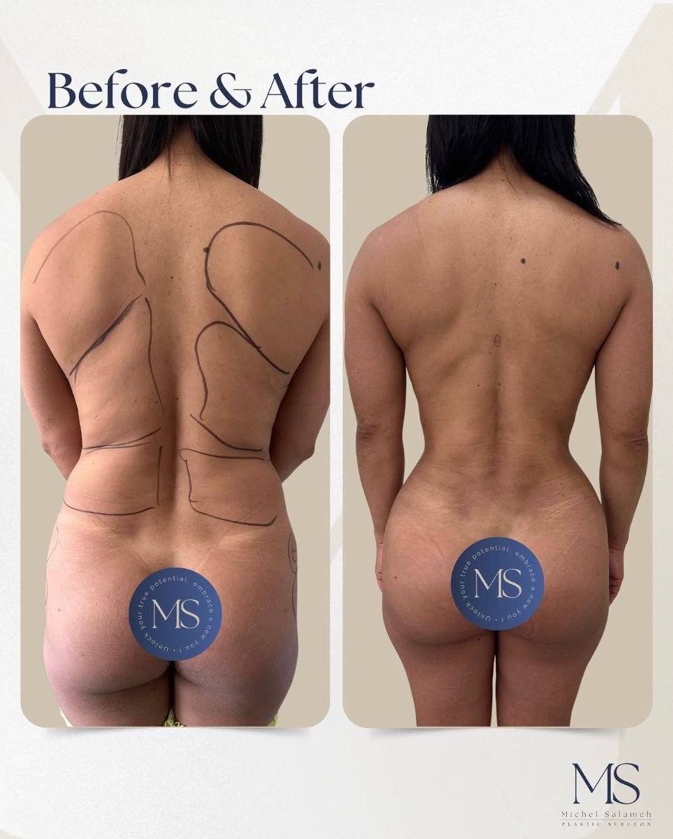 نتائج قبل وبعد عملية تجميل الأم في عيادة MS – تحسين واضح لتناسق الجسم