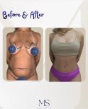 Mommy makeover before and after results at Michel Salameh Clinic – body contour improvement