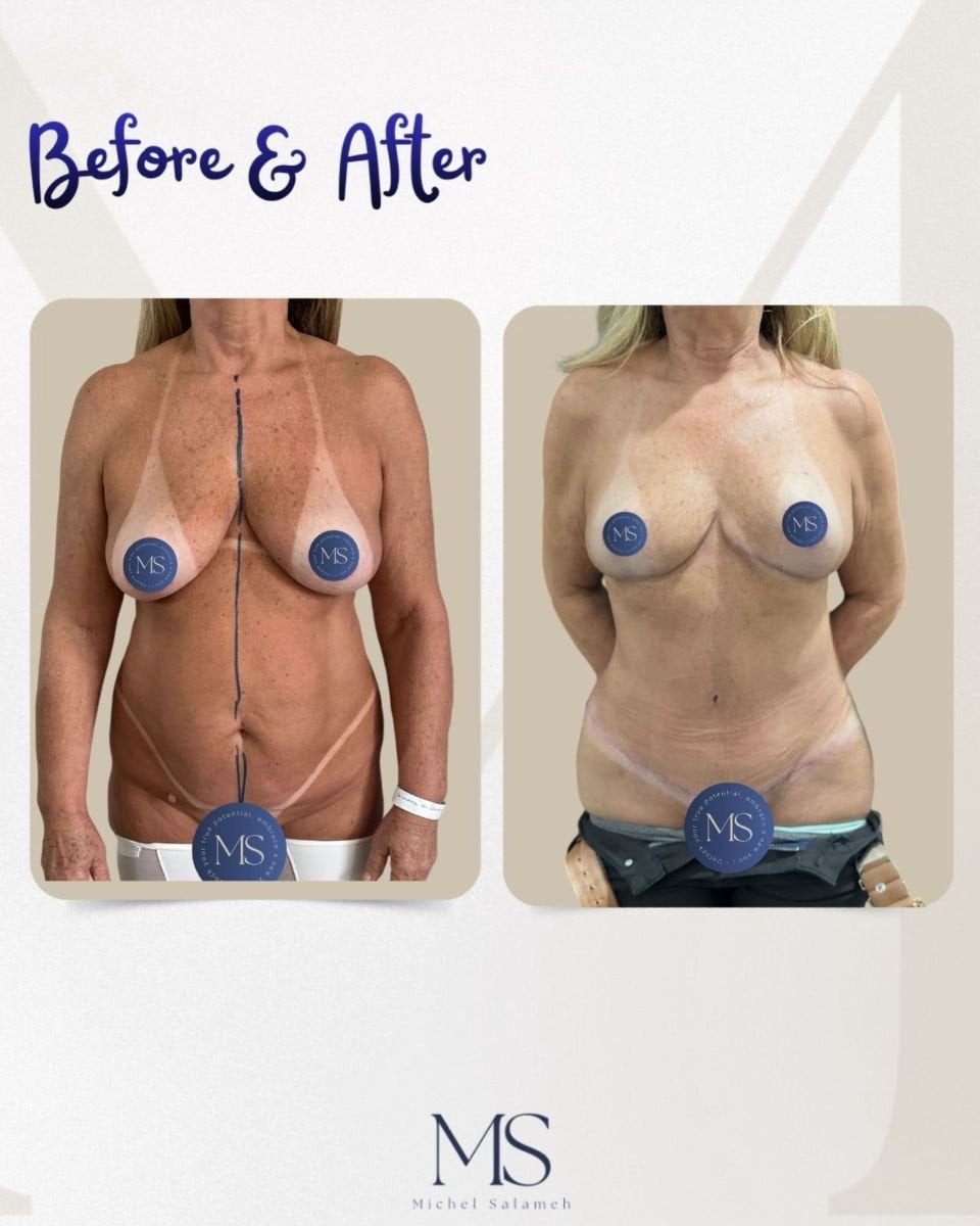 Resultados de mommy makeover antes y después en Michel Salameh Clinic – mejora corporal