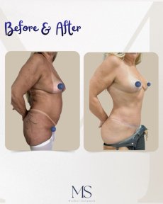 Mommy makeover before and after results at Michel Salameh Clinic – body contour improvement