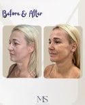Before and after deep plane facelift results at Michel Salameh Clinic, facial rejuvenation
