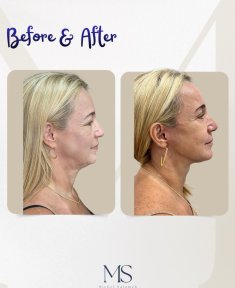 Before and after deep plane facelift results at MS Clinic – visible facial rejuvenation