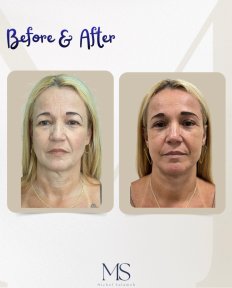 Результаты до и после deep plane facelift в клинике Michel Salameh, омоложение лица