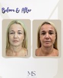Результаты до и после deep plane facelift в клинике Michel Salameh, омоложение лица