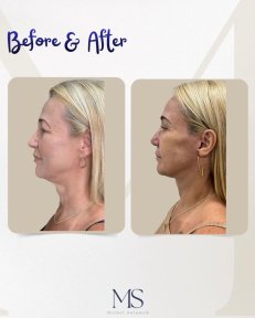 Before and after deep plane facelift results at Michel Salameh Clinic, visible jawline lift