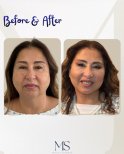 Результаты до и после deep plane facelift в клинике Michel Salameh, омоложение лица